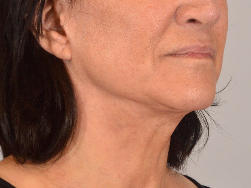 Facelift & Necklift Before & After Gallery - Patient 156087 - Image 3