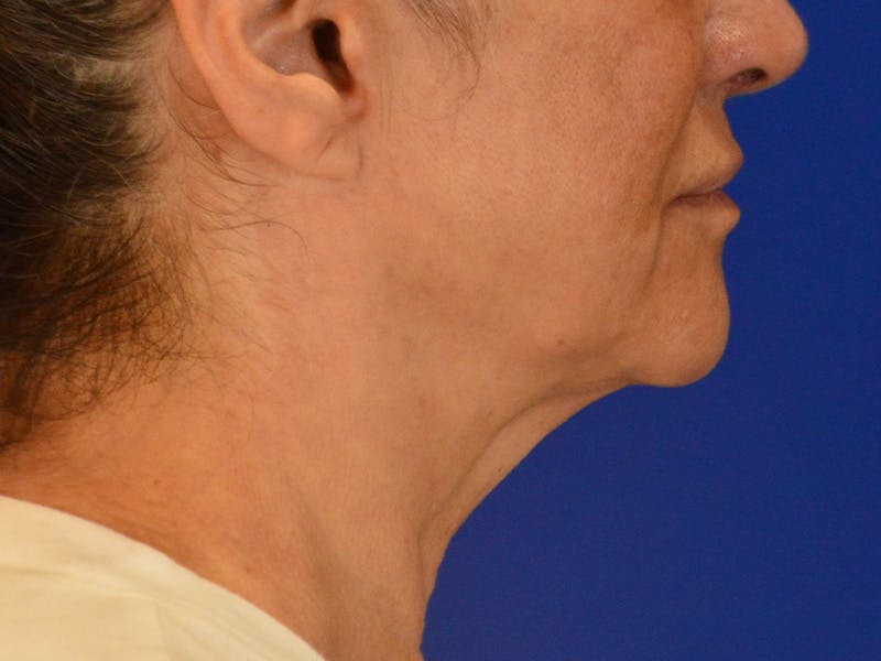 Facelift & Necklift Before & After Gallery - Patient 156087 - Image 5