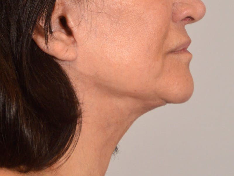 Facelift & Necklift Before & After Gallery - Patient 156087 - Image 6