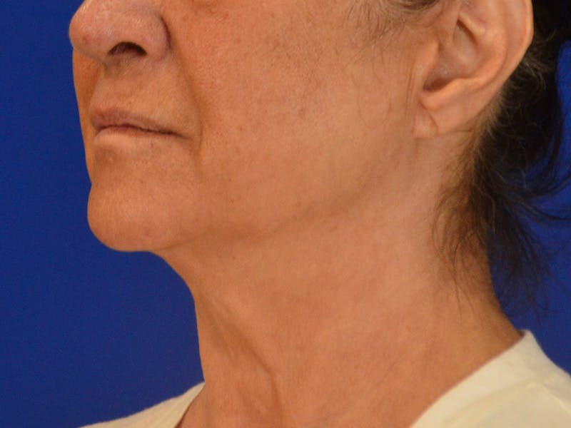 Facelift & Necklift Before & After Gallery - Patient 156087 - Image 7