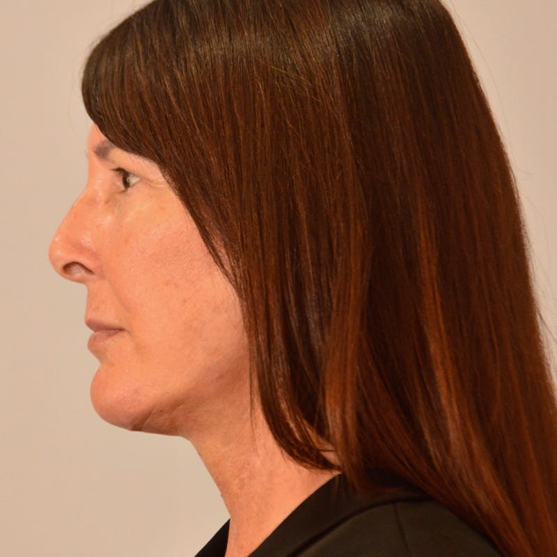Facelift & Necklift Before & After Gallery - Patient 316007 - Image 12