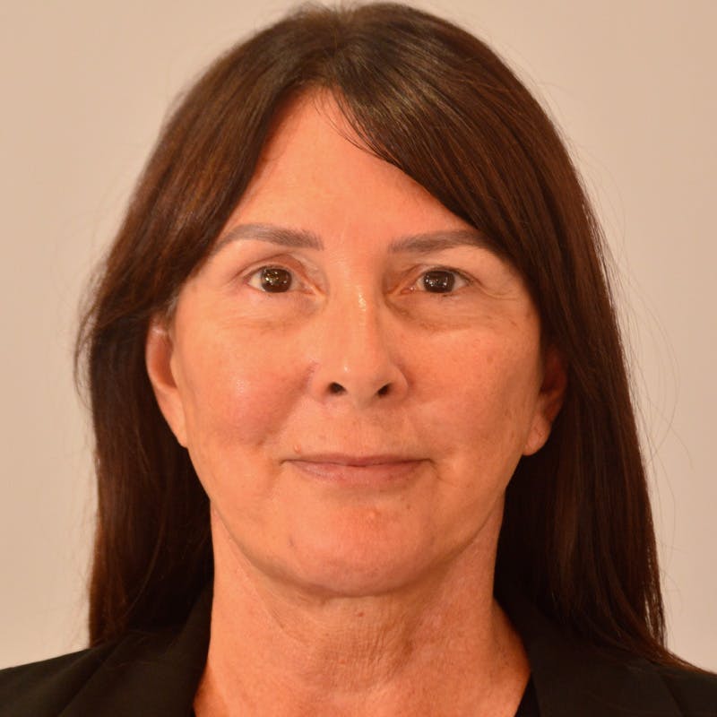 Facelift & Necklift Before & After Gallery - Patient 316007 - Image 2