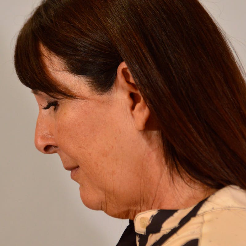Facelift & Necklift Before & After Gallery - Patient 316007 - Image 13