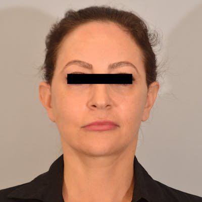 Facelift & Necklift Before & After Gallery - Patient 385234 - Image 2
