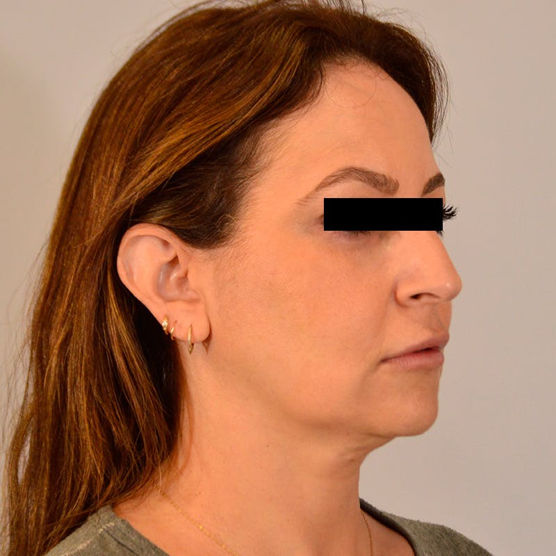 Facelift & Necklift Before & After Gallery - Patient 385234 - Image 3