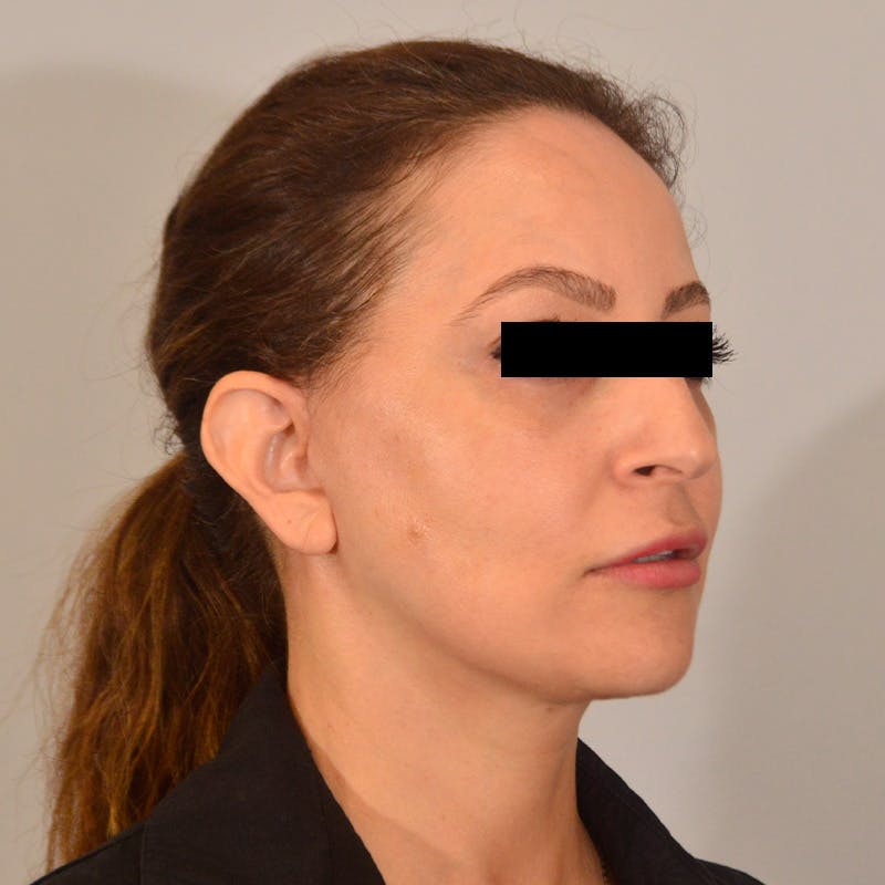 Facelift & Necklift Before & After Gallery - Patient 385234 - Image 4