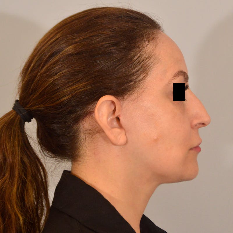 Facelift & Necklift Before & After Gallery - Patient 385234 - Image 6