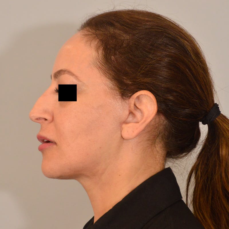 Facelift & Necklift Before & After Gallery - Patient 385234 - Image 10