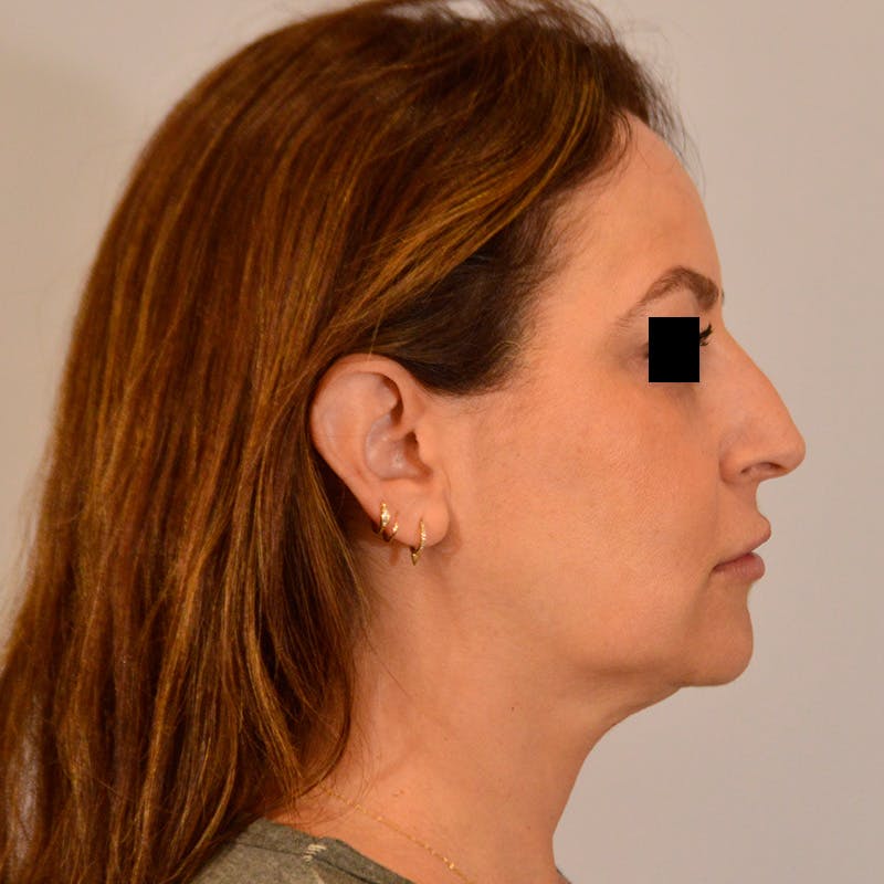 Facelift & Necklift Before & After Gallery - Patient 385234 - Image 5