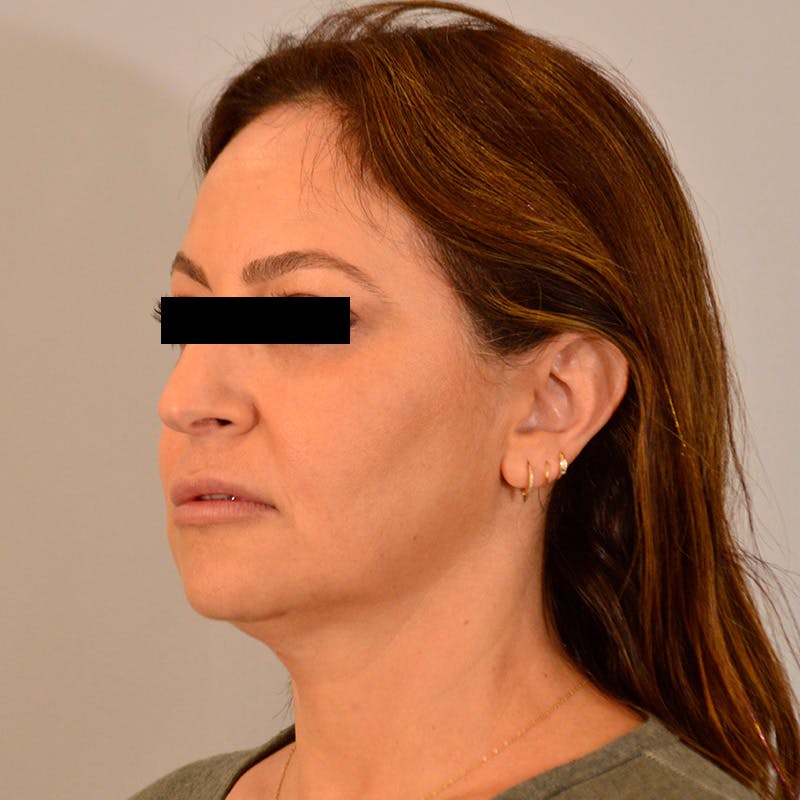 Facelift & Necklift Before & After Gallery - Patient 385234 - Image 7