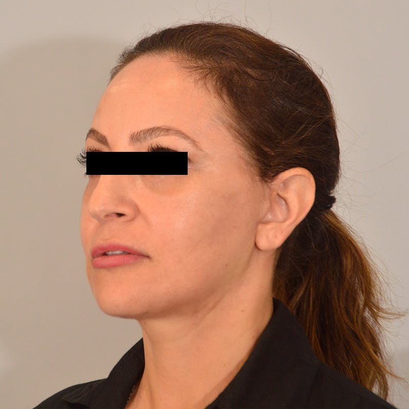 Facelift & Necklift Before & After Gallery - Patient 385234 - Image 8