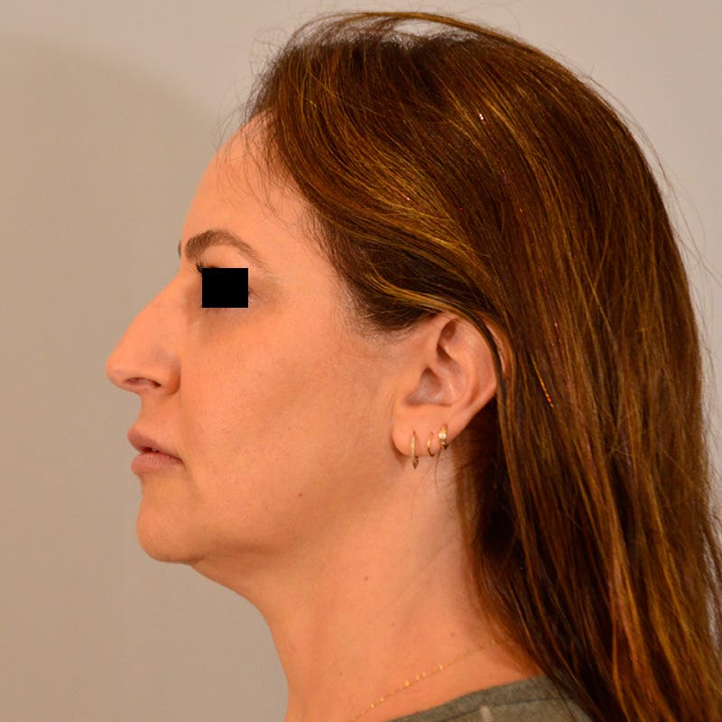 Facelift & Necklift Before & After Gallery - Patient 385234 - Image 9