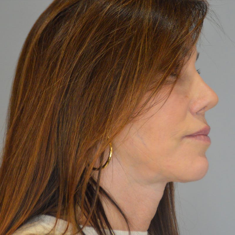 Buccal Fat Removal Before & After Gallery - Patient 202830 - Image 4