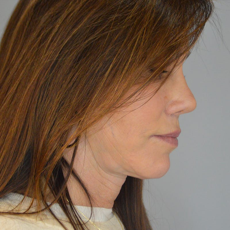 Buccal Fat Removal Before & After Gallery - Patient 202830 - Image 6