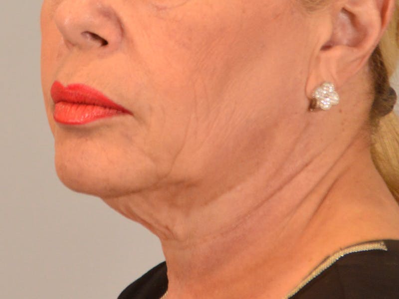 Facelift & Necklift Before & After Gallery - Patient 238339 - Image 5