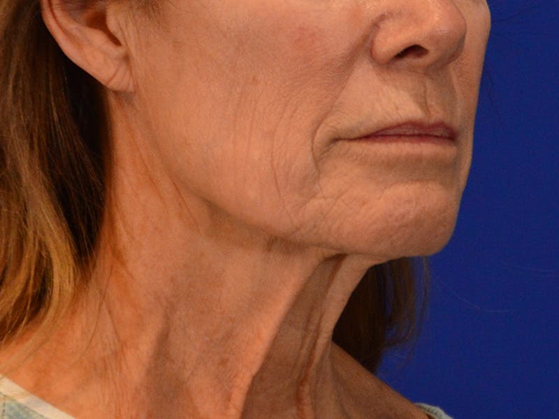 Facelift & Necklift Before & After Gallery - Patient 276789 - Image 3