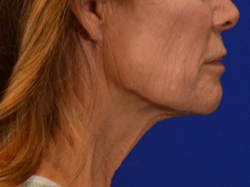 Facelift & Necklift Before & After Gallery - Patient 276789 - Image 5