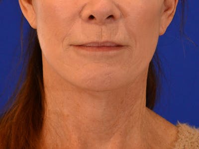 Facelift & Necklift Before & After Gallery - Patient 276789 - Image 2