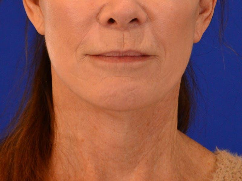 Facelift & Necklift Before & After Gallery - Patient 276789 - Image 2