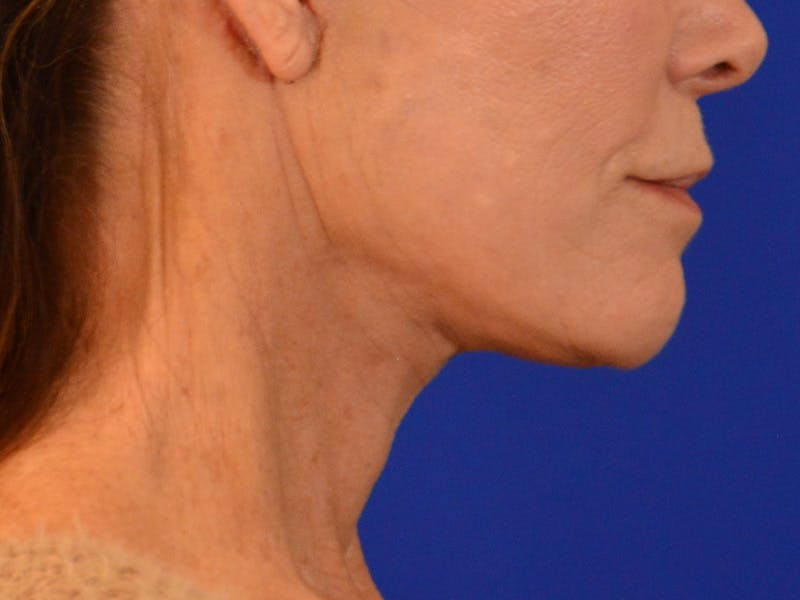 Facelift & Necklift Before & After Gallery - Patient 276789 - Image 6