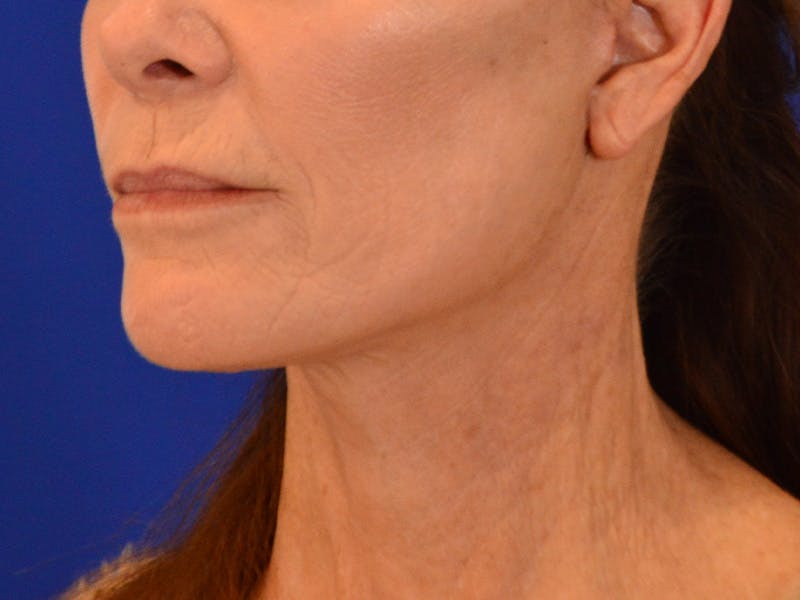Facelift & Necklift Before & After Gallery - Patient 276789 - Image 8