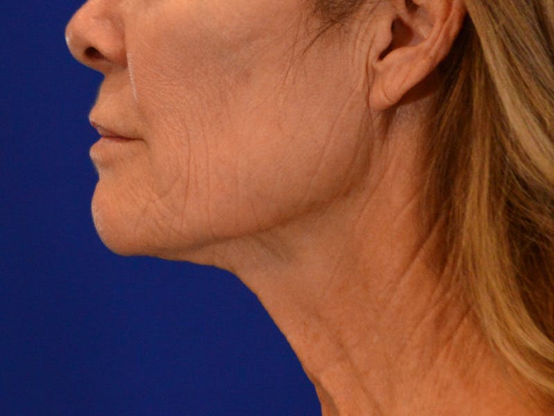Facelift & Necklift Before & After Gallery - Patient 276789 - Image 9