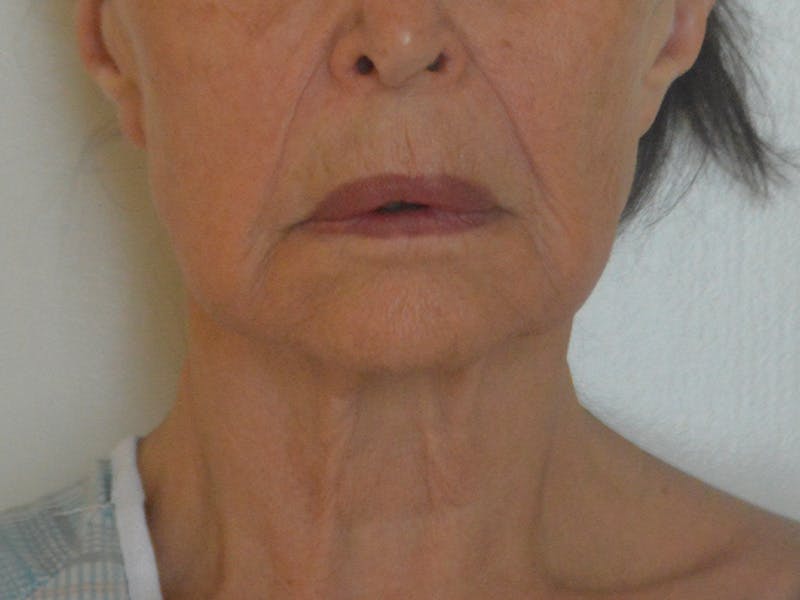 Buccal Fat Removal Before & After Gallery - Patient 724116 - Image 1