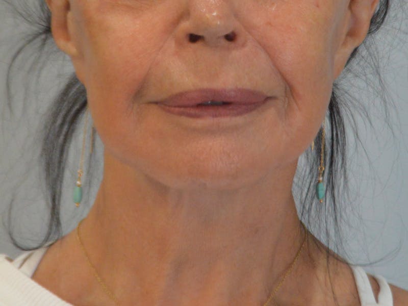 Buccal Fat Removal Before & After Gallery - Patient 724116 - Image 2