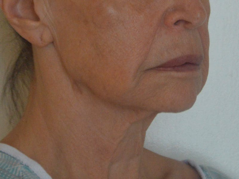 Buccal Fat Removal Before & After Gallery - Patient 724116 - Image 3