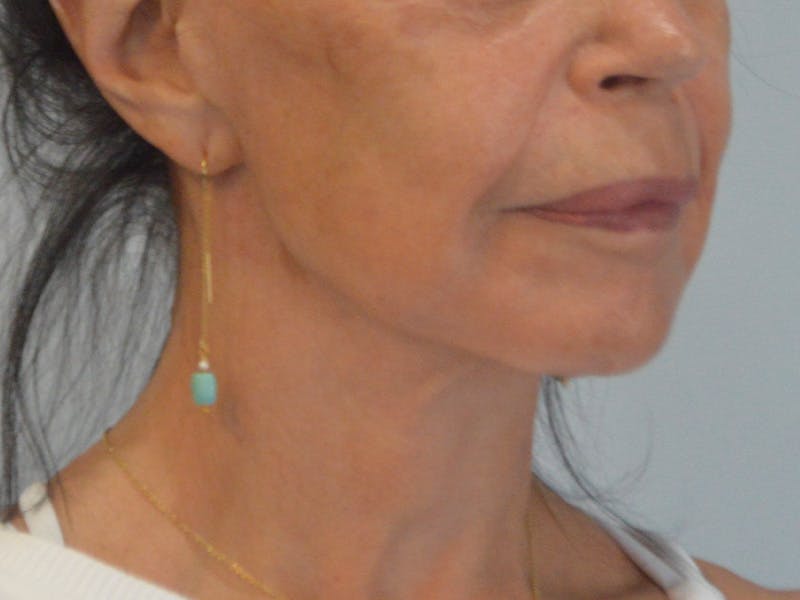Buccal Fat Removal Before & After Gallery - Patient 724116 - Image 4