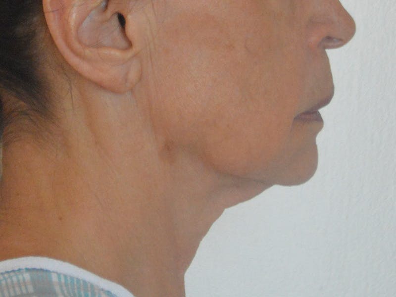 Buccal Fat Removal Before & After Gallery - Patient 724116 - Image 5