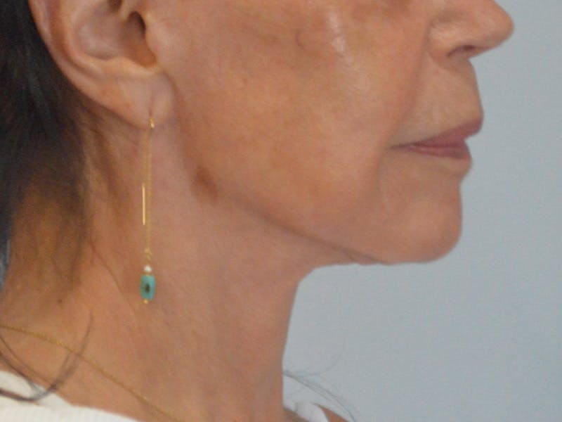Buccal Fat Removal Before & After Gallery - Patient 724116 - Image 6
