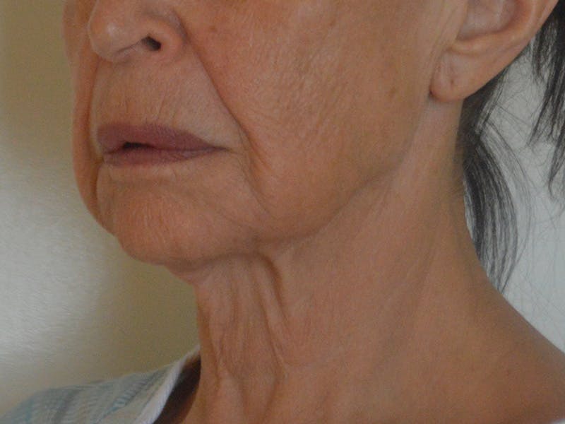 Buccal Fat Removal Before & After Gallery - Patient 724116 - Image 7