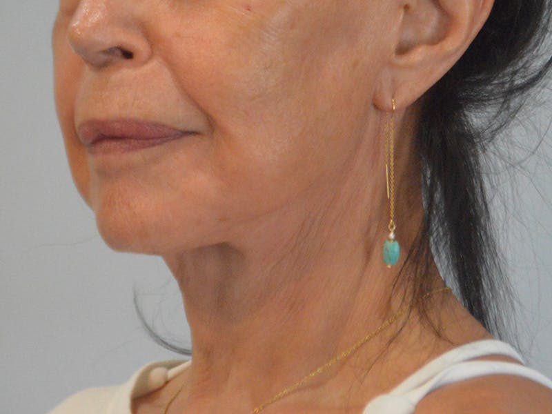 Buccal Fat Removal Before & After Gallery - Patient 724116 - Image 8