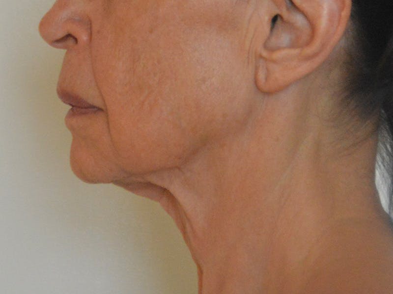 Buccal Fat Removal Before & After Gallery - Patient 724116 - Image 9