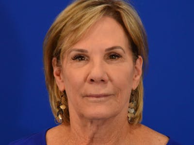 Facelift & Necklift Before & After Gallery - Patient 194467 - Image 1