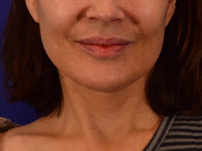 Facelift & Necklift Before & After Gallery - Patient 189533 - Image 2