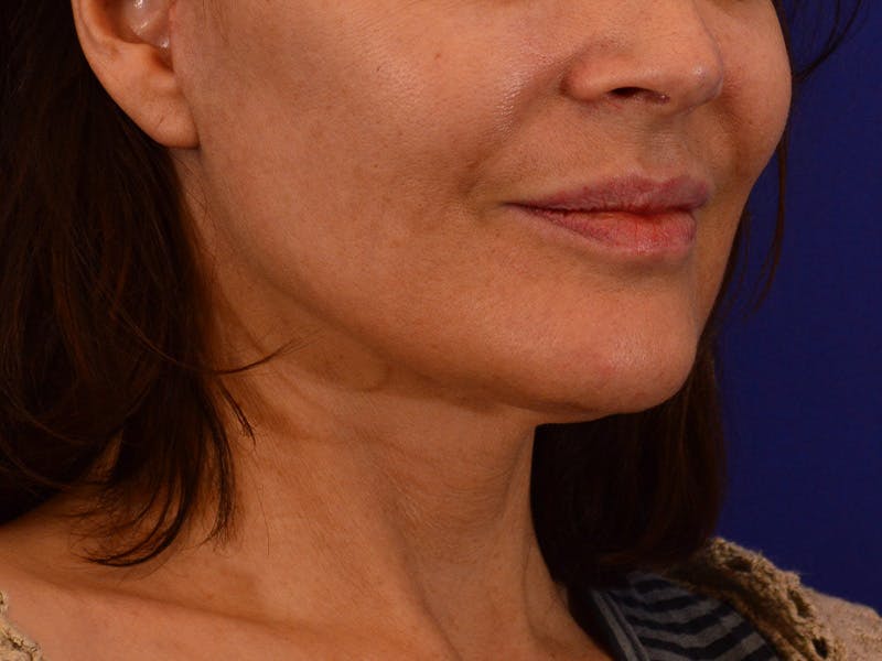 Facelift & Necklift Before & After Gallery - Patient 189533 - Image 4
