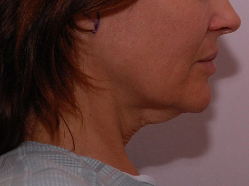 Facelift & Necklift Before & After Gallery - Patient 189533 - Image 5