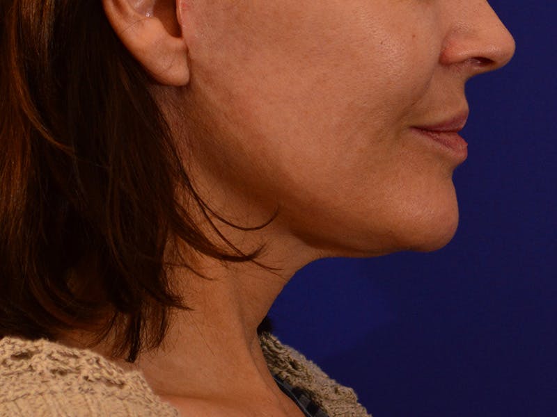 Facelift & Necklift Before & After Gallery - Patient 189533 - Image 6