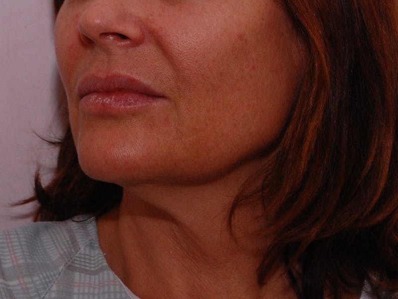 Facelift & Necklift Before & After Gallery - Patient 189533 - Image 7