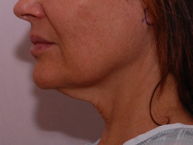 Facelift & Necklift Before & After Gallery - Patient 189533 - Image 9