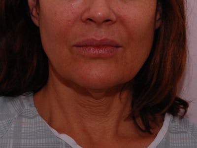 Facelift & Necklift Before & After Gallery - Patient 189533 - Image 1