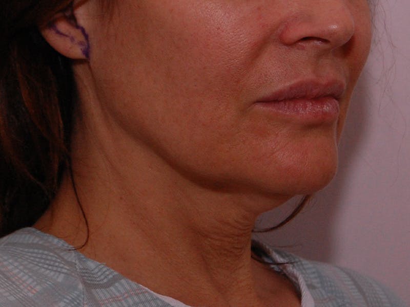 Facelift & Necklift Before & After Gallery - Patient 189533 - Image 3