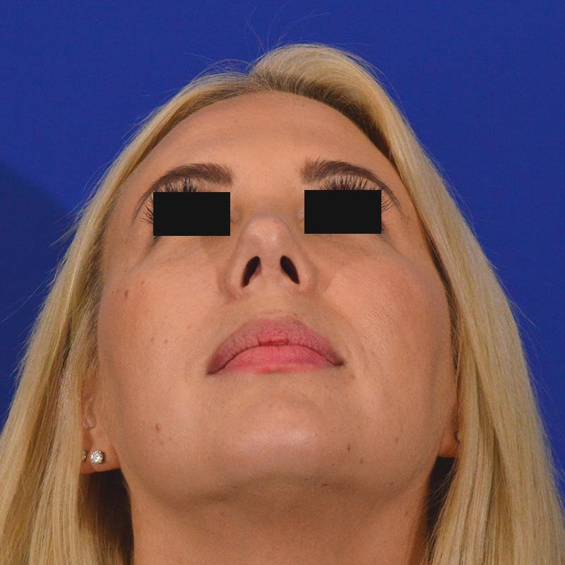 rhinoplasty patient after Beverly Hills by Dr. Torkian