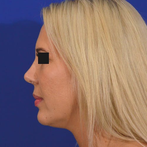 rhinoplasty patient after Beverly Hills by Dr. Torkian