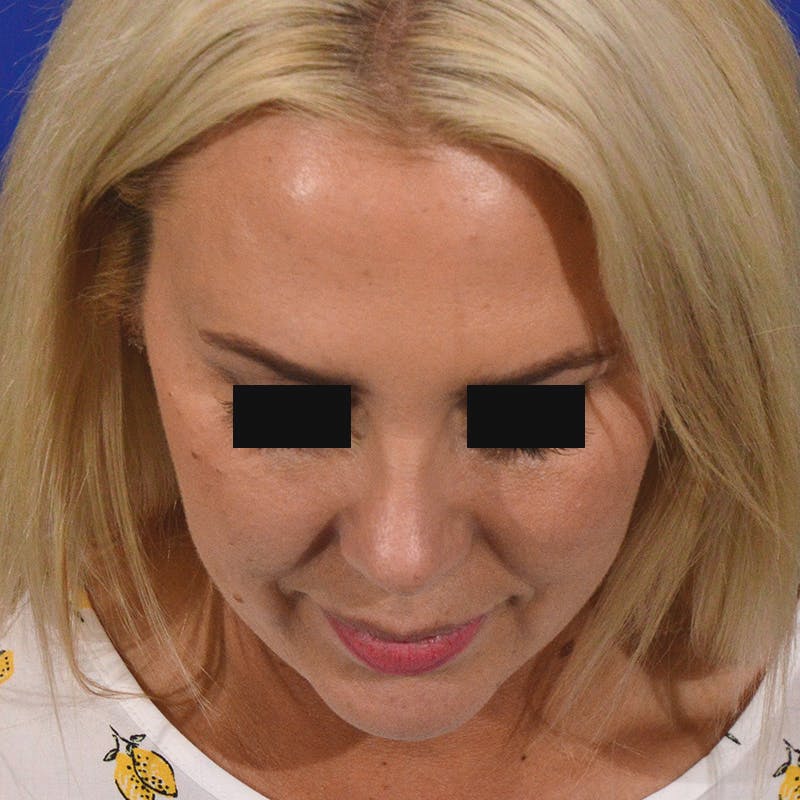 rhinoplasty patient after Beverly Hills by Dr. Torkian
