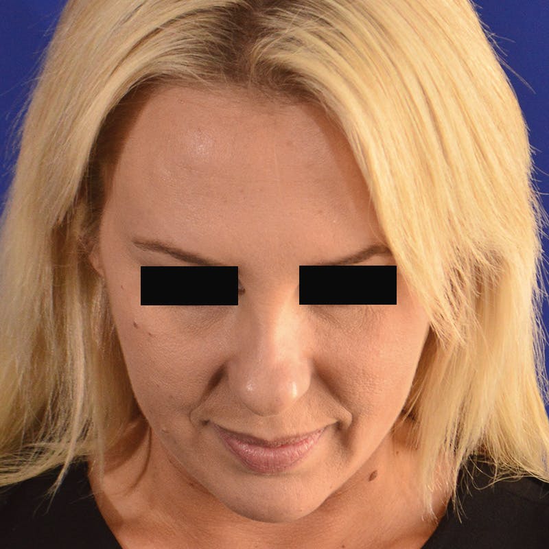 rhinoplasty patient before Beverly Hills by Dr. Torkian