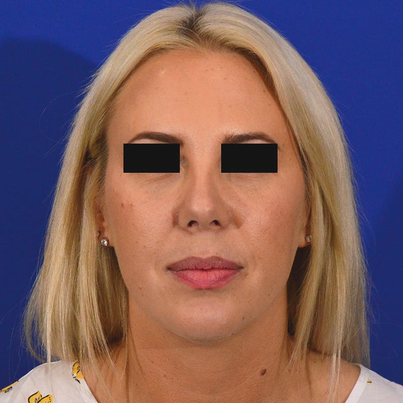 rhinoplasty patient after Beverly Hills by Dr. Torkian