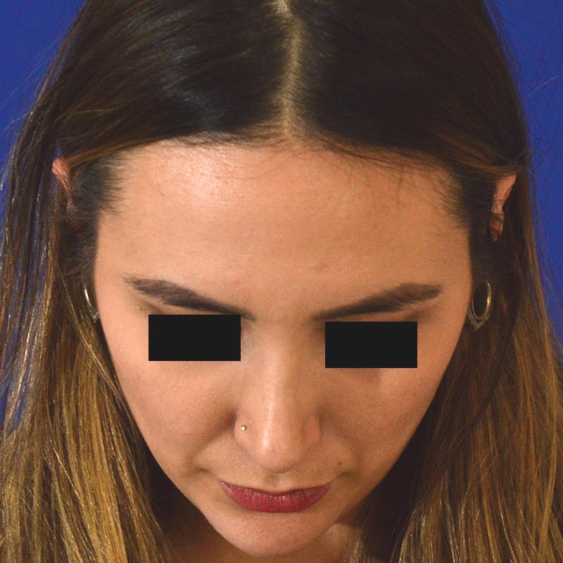 rhinoplasty patient after Beverly Hills by Dr. Torkian